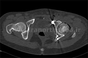 نمونه های جراحی شکستگی های دوستونی استابولوم. بررسی تخصصی 62 شکستگی دو ستونی استابولوم لگن