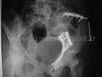 نمونه های جراحی شکستگی های دوستونی استابولوم. بررسی تخصصی 54 شکستگی دو ستونی استابولوم لگن