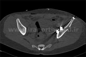نمونه های جراحی شکستگی های دوستونی استابولوم. بررسی تخصصی 57 شکستگی دو ستونی استابولوم لگن