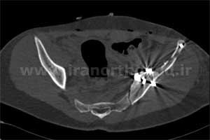 نمونه های جراحی شکستگی های دوستونی استابولوم. بررسی تخصصی 56 شکستگی دو ستونی استابولوم لگن