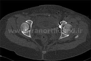 نمونه های جراحی شکستگی های دوستونی استابولوم. بررسی تخصصی 91 شکستگی دو ستونی استابولوم لگن