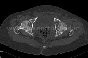 نمونه های جراحی شکستگی های دوستونی استابولوم. بررسی تخصصی 78 شکستگی دو ستونی استابولوم لگن