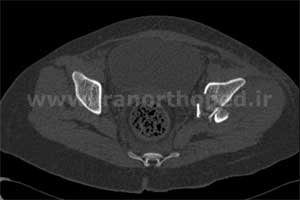 نمونه های جراحی شکستگی های دوستونی استابولوم. بررسی تخصصی 73 شکستگی دو ستونی استابولوم لگن
