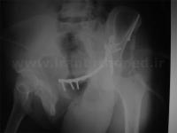 نمونه های جراحی شکستگی های دوستونی استابولوم. بررسی تخصصی 81 شکستگی دو ستونی استابولوم لگن