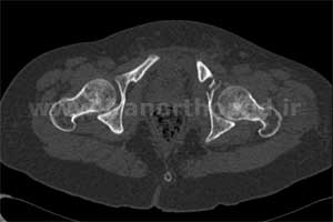 نمونه های جراحی شکستگی های دوستونی استابولوم. بررسی تخصصی 79 شکستگی دو ستونی استابولوم لگن