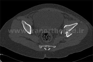 نمونه های جراحی شکستگی های دوستونی استابولوم. بررسی تخصصی 72 شکستگی دو ستونی استابولوم لگن