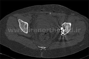 نمونه های جراحی شکستگی های دوستونی استابولوم. بررسی تخصصی 87 شکستگی دو ستونی استابولوم لگن