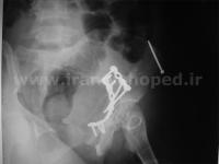 نمونه های جراحی شکستگی های دوستونی استابولوم. بررسی تخصصی 82 شکستگی دو ستونی استابولوم لگن