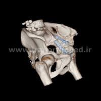 نمونه های جراحی شکستگی های دوستونی استابولوم. بررسی تخصصی 96 شکستگی دو ستونی استابولوم لگن