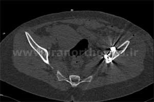 نمونه های جراحی شکستگی های دوستونی استابولوم. بررسی تخصصی 84 شکستگی دو ستونی استابولوم لگن