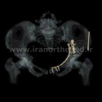 نمونه های جراحی شکستگی های دوستونی استابولوم. بررسی تخصصی 98 شکستگی دو ستونی استابولوم لگن