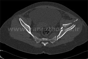 نمونه های جراحی شکستگی های دوستونی استابولوم. بررسی تخصصی 69 شکستگی دو ستونی استابولوم لگن