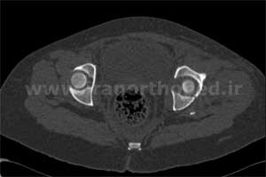 نمونه های جراحی شکستگی های دوستونی استابولوم. بررسی تخصصی 76 شکستگی دو ستونی استابولوم لگن