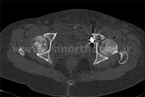 نمونه های جراحی شکستگی های دوستونی استابولوم. بررسی تخصصی 93 شکستگی دو ستونی استابولوم لگن
