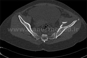 نمونه های جراحی شکستگی های دوستونی استابولوم. بررسی تخصصی 68 شکستگی دو ستونی استابولوم لگن