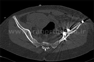 نمونه های جراحی شکستگی های دوستونی استابولوم. بررسی تخصصی 83 شکستگی دو ستونی استابولوم لگن