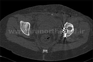 نمونه های جراحی شکستگی های دوستونی استابولوم. بررسی تخصصی 88 شکستگی دو ستونی استابولوم لگن