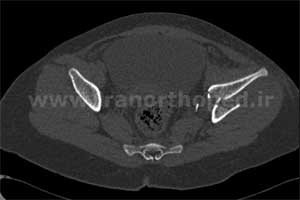 نمونه های جراحی شکستگی های دوستونی استابولوم. بررسی تخصصی 71 شکستگی دو ستونی استابولوم لگن
