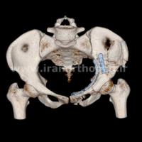 نمونه های جراحی شکستگی های دوستونی استابولوم. بررسی تخصصی 95 شکستگی دو ستونی استابولوم لگن