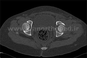نمونه های جراحی شکستگی های دوستونی استابولوم. بررسی تخصصی 77 شکستگی دو ستونی استابولوم لگن
