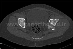 نمونه های جراحی شکستگی های دوستونی استابولوم. بررسی تخصصی 74 شکستگی دو ستونی استابولوم لگن