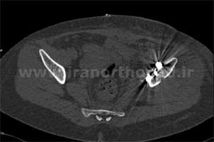 نمونه های جراحی شکستگی های دوستونی استابولوم. بررسی تخصصی 85 شکستگی دو ستونی استابولوم لگن