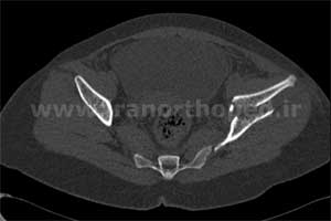 نمونه های جراحی شکستگی های دوستونی استابولوم. بررسی تخصصی 70 شکستگی دو ستونی استابولوم لگن