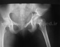 نمونه های جراحی شکستگی های دوستونی استابولوم. بررسی تخصصی 67 شکستگی دو ستونی استابولوم لگن