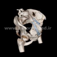 نمونه های جراحی شکستگی های دوستونی استابولوم. بررسی تخصصی 94 شکستگی دو ستونی استابولوم لگن