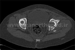 نمونه های جراحی شکستگی های دوستونی استابولوم. بررسی تخصصی 75 شکستگی دو ستونی استابولوم لگن