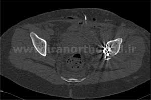نمونه های جراحی شکستگی های دوستونی استابولوم. بررسی تخصصی 86 شکستگی دو ستونی استابولوم لگن