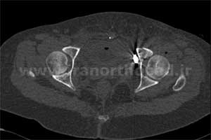نمونه های جراحی شکستگی های دوستونی استابولوم. بررسی تخصصی 92 شکستگی دو ستونی استابولوم لگن