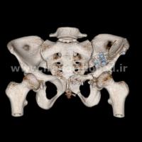 نمونه های جراحی شکستگی های دوستونی استابولوم. بررسی تخصصی 97 شکستگی دو ستونی استابولوم لگن
