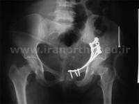 نمونه های جراحی شکستگی های دوستونی استابولوم. بررسی تخصصی 80 شکستگی دو ستونی استابولوم لگن