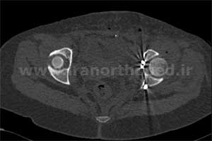 نمونه های جراحی شکستگی های دوستونی استابولوم. بررسی تخصصی 90 شکستگی دو ستونی استابولوم لگن