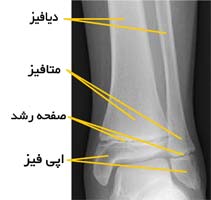 شکستگی صفحه رشد در بچه ها 3 709 1