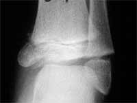 شکستگی صفحه رشد در بچه ها 14 شکستگی صفحه رشد نوع پنجم