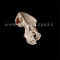 نمونه های جراحی شکستگی های دوستونی استابولوم. بررسی تخصصی 13 شکستگی ستون قدامی استابولوم لگن