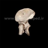 نمونه های جراحی شکستگی های دوستونی استابولوم. بررسی تخصصی 14 شکستگی ستون قدامی استابولوم لگن