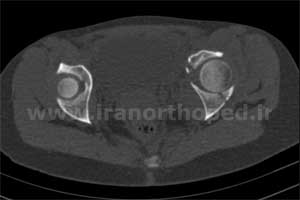 نمونه های جراحی شکستگی های دوستونی استابولوم. بررسی تخصصی 10 شکستگی ستون قدامی استابولوم لگن
