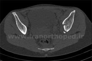 نمونه های جراحی شکستگی های دوستونی استابولوم. بررسی تخصصی 5 شکستگی ستون قدامی استابولوم لگن