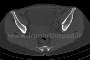 نمونه های جراحی شکستگی های دوستونی استابولوم. بررسی تخصصی 4 شکستگی ستون قدامی استابولوم لگن