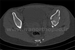 نمونه های جراحی شکستگی های دوستونی استابولوم. بررسی تخصصی 6 شکستگی ستون قدامی استابولوم لگن