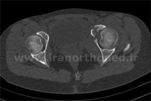 نمونه های جراحی شکستگی های دوستونی استابولوم. بررسی تخصصی 11 شکستگی ستون قدامی استابولوم لگن