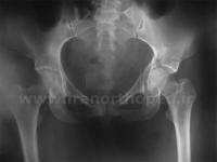 نمونه های جراحی شکستگی های دوستونی استابولوم. بررسی تخصصی 2 شکستگی ستون قدامی استابولوم لگن
