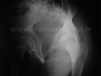 نمونه های جراحی شکستگی های دوستونی استابولوم. بررسی تخصصی 3 شکستگی ستون قدامی استابولوم لگن
