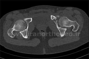 نمونه های جراحی شکستگی های دوستونی استابولوم. بررسی تخصصی 12 شکستگی ستون قدامی استابولوم لگن