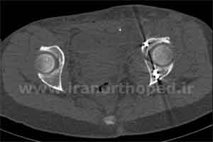 نمونه های جراحی شکستگی های دوستونی استابولوم. بررسی تخصصی 20 شکستگی ستون قدامی استابولوم لگن