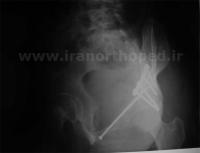 نمونه های جراحی شکستگی های دوستونی استابولوم. بررسی تخصصی 16 شکستگی ستون قدامی استابولوم لگن