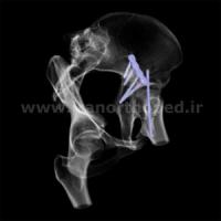 نمونه های جراحی شکستگی های دوستونی استابولوم. بررسی تخصصی 27 شکستگی ستون قدامی استابولوم لگن